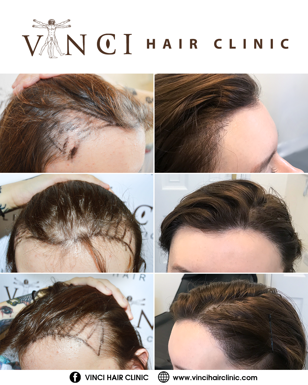 It's Time to Talk About Female Hair Loss – Vinci Hair Clinic
