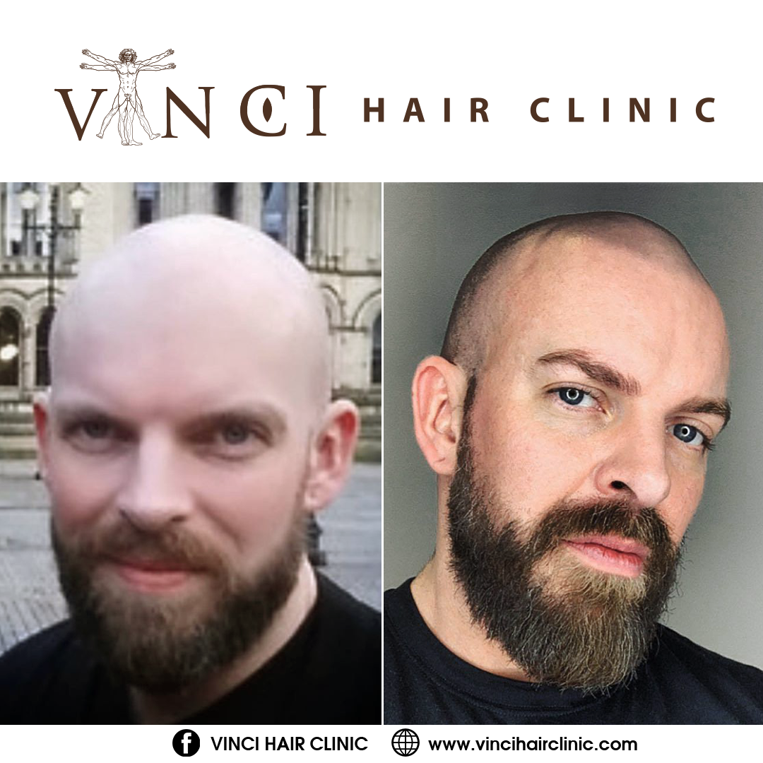Six Common Hair Loss Conditions - Vinci Hair Clinic
