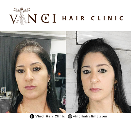 Add More Volume To Your Flat Hair! - Vinci Hair Clinic