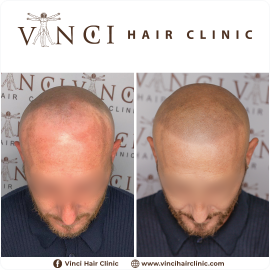 MSP - Vinci Hair Clinic JOHN KELLY