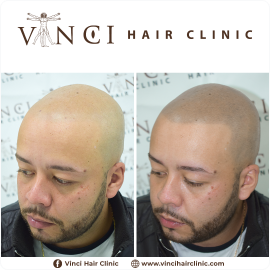 MSP - Vinci Hair Clinic - Jonathan Firmino - Brazil 22-06-2021 03 1