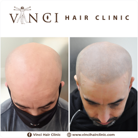 Micro Scalp Pigmentation (MSP) treatment at our Harley Street clinic.