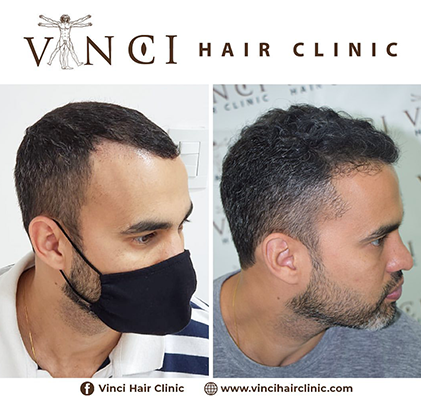 What Is A Damaged Hair Follicle And How Do You Fix It? - Vinci Hair Clinic