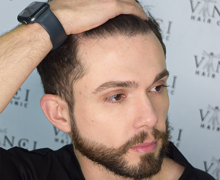 I Want a Hair Transplant: Am I a Suitable Candidate? - Vinci Hair Clinic