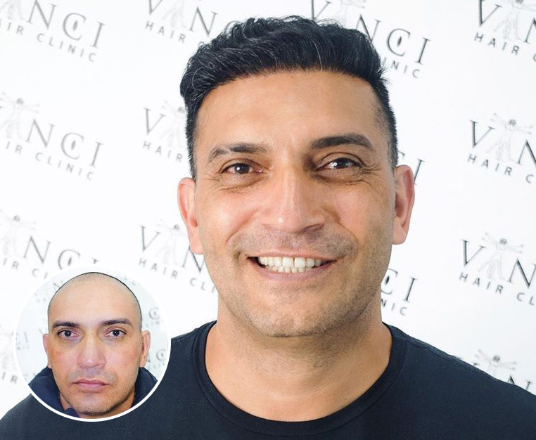 Why Don't We Have a National Hair Transplant Day? - Vinci Hair Clinic