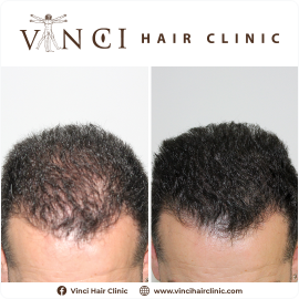 Micro Scalp Pigmentation treatment to improve hair volume and density.
