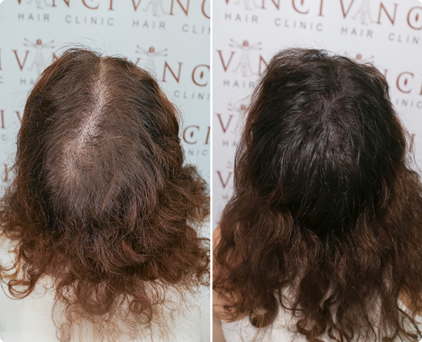 Female MSP For Long & Thinning Hair Results
