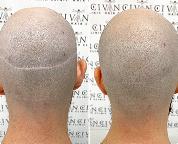 MSP For Hair Transplant Scars Results