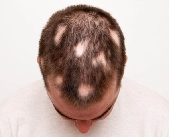 Vinci MSP For Alopecia