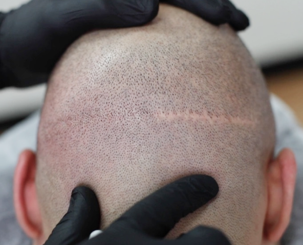 Vinci MSP For Hair Transplant Scars